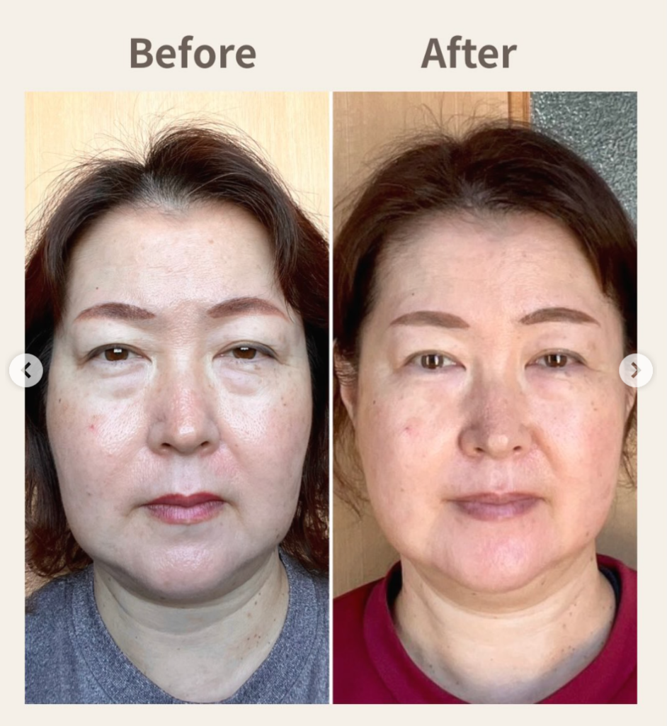 beforeafter_表情筋トレーニング
